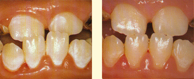 歯と歯ぐきの境目が白くなってむし歯のなりかけになっていたが，適切なフッ素の使用によって半年後には治癒している。